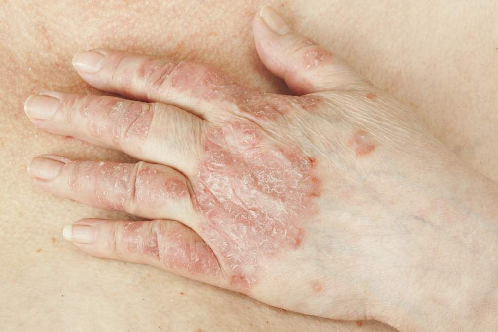 Psoriasis, a condition that causes red, scaly patches of ...
