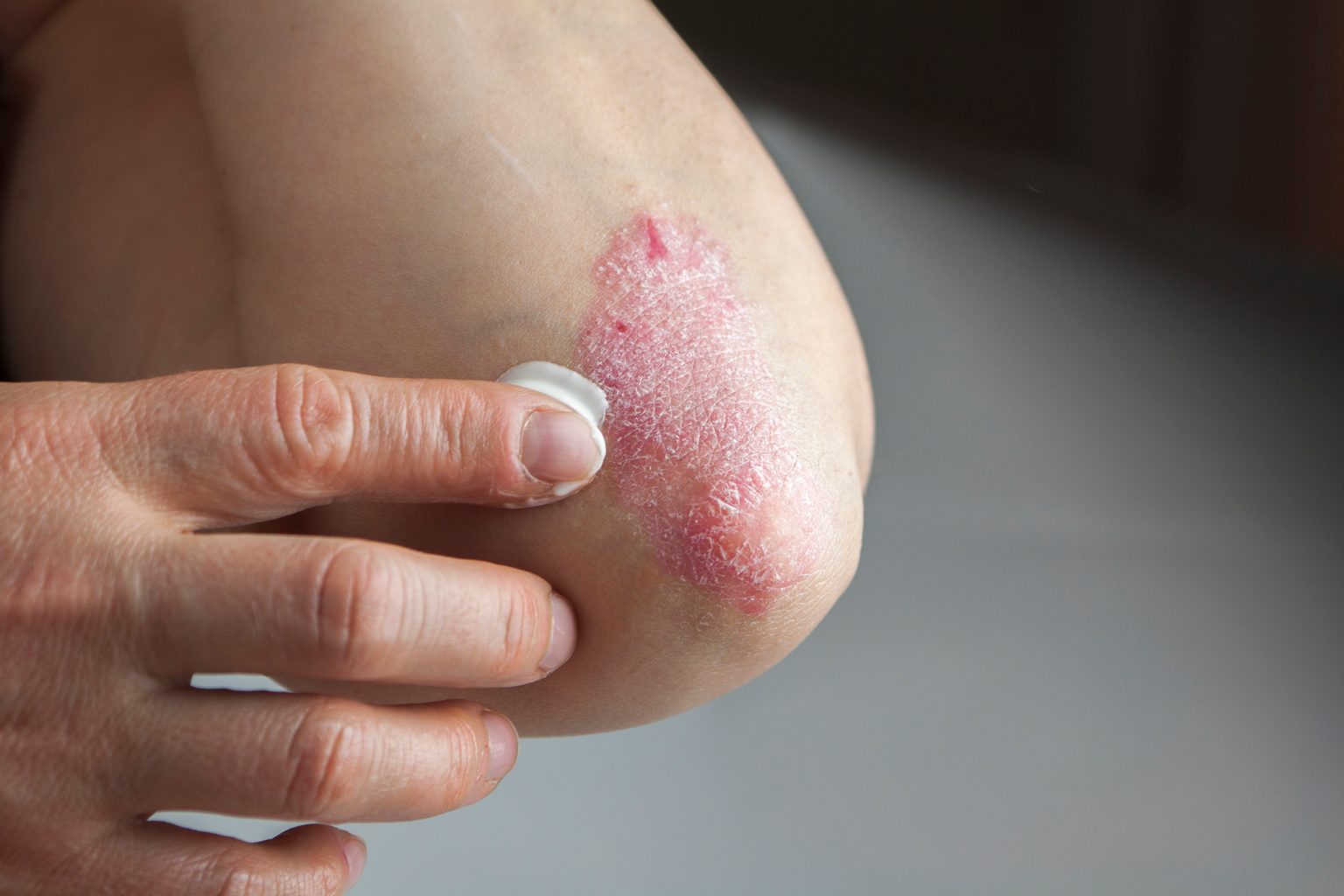 Psoriasis: A Guide to Symptoms, Causes, Types, Treatments