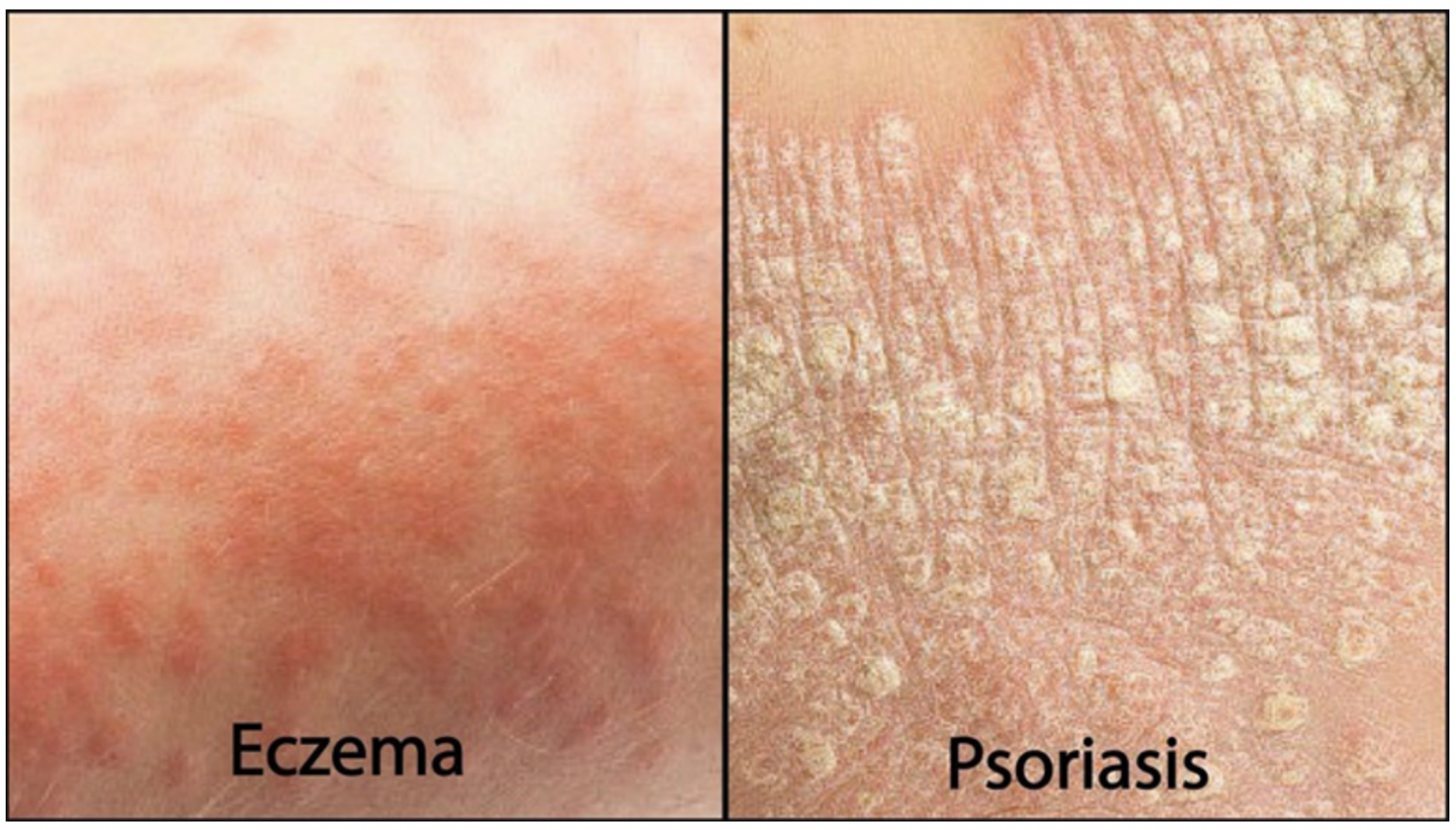 Psoriasis and Eczema: What
