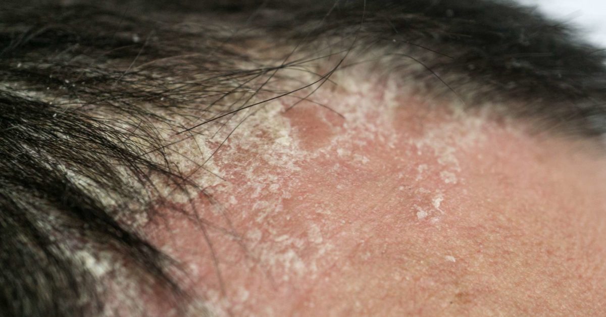 Psoriasis and hair loss: Scalp psoriasis, symptoms, prevention