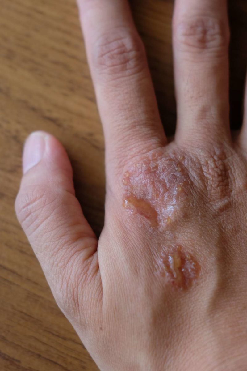 Psoriasis and HIV: What is the link?
