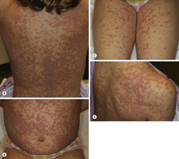 Psoriasis and Other Papulosquamous Diseases