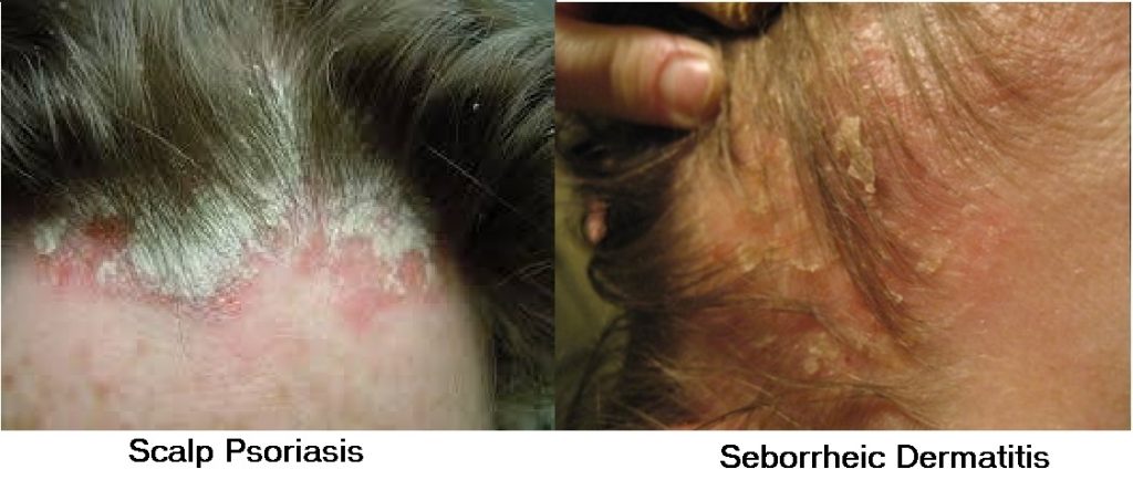 Psoriasis and Psoriasis on Face Problems. The Complete ...