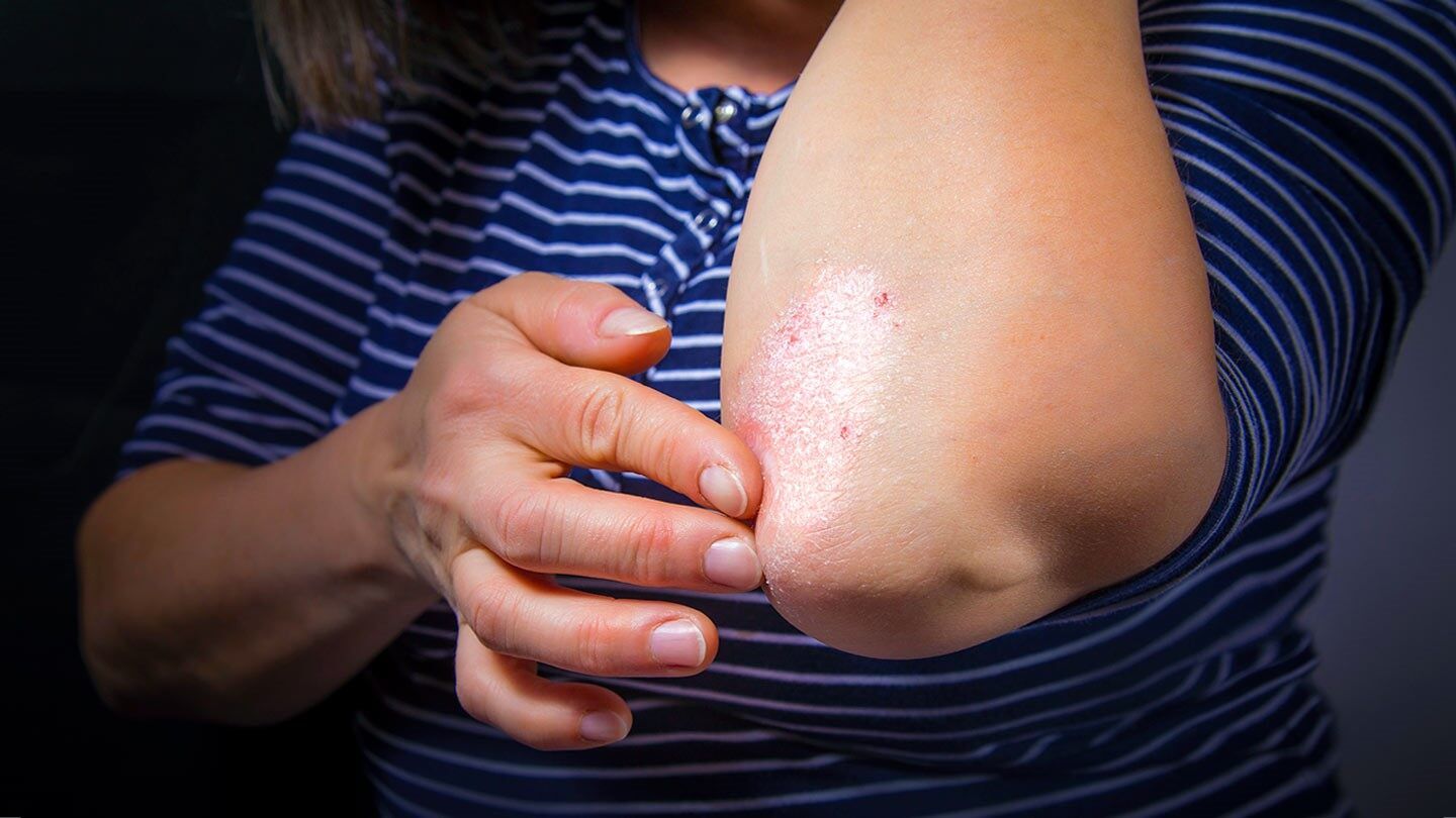 Psoriasis and Scarring: How to Stop the Pattern