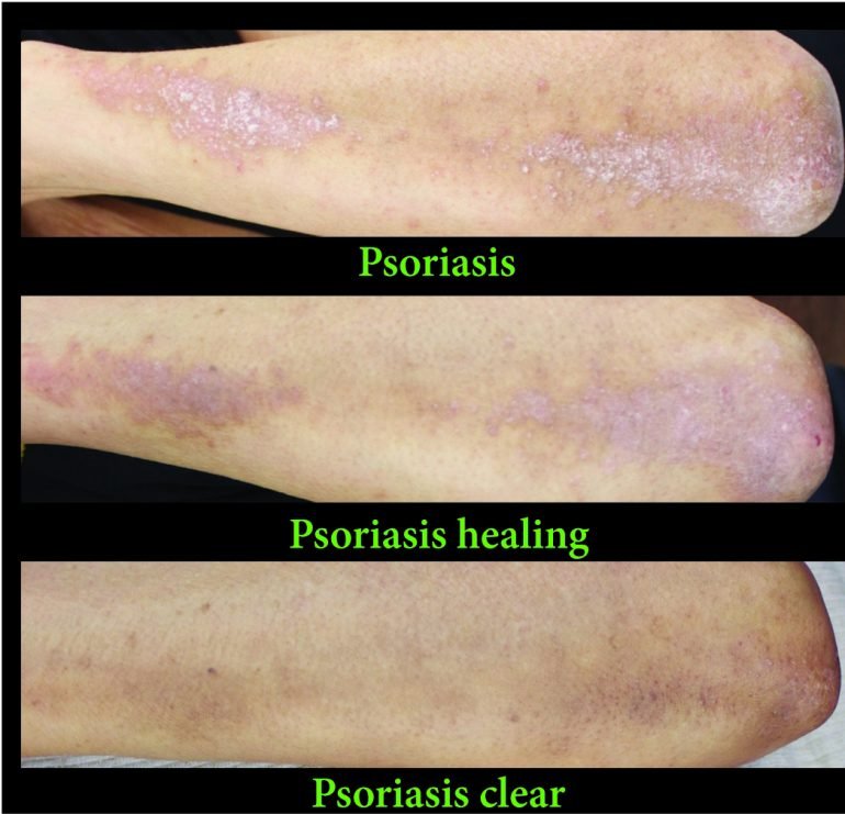 Psoriasis and the stages of healing