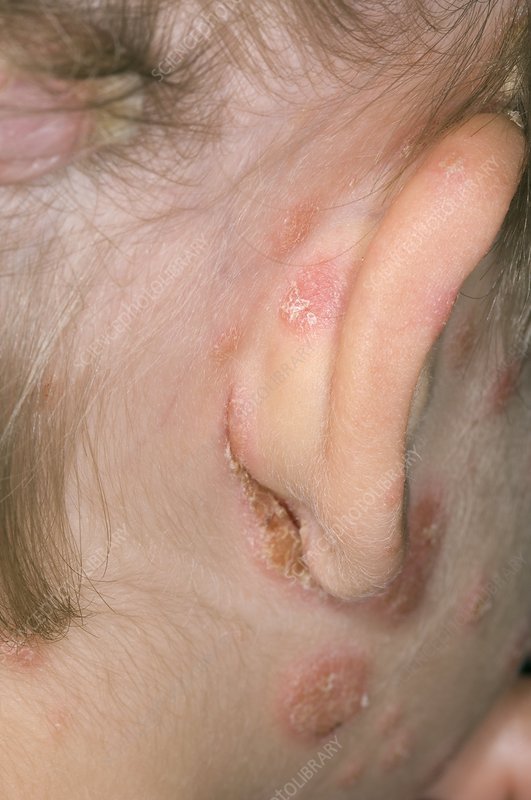 Psoriasis around the ear