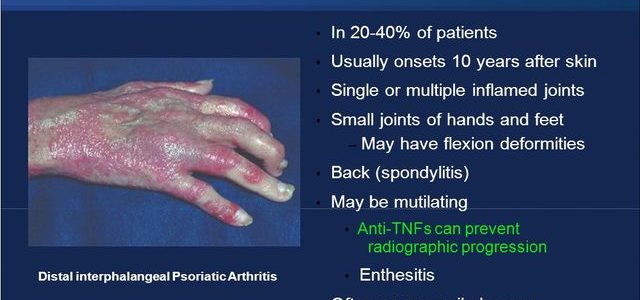 Psoriasis Arthritis Life Expectancy