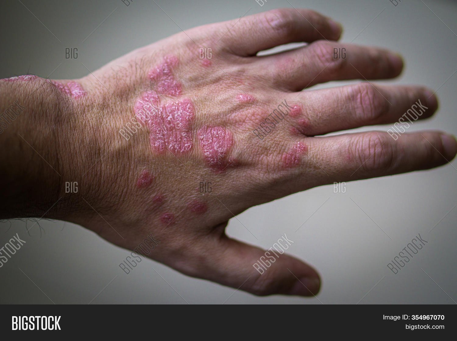Psoriasis. Autoimmune Image &  Photo (Free Trial)