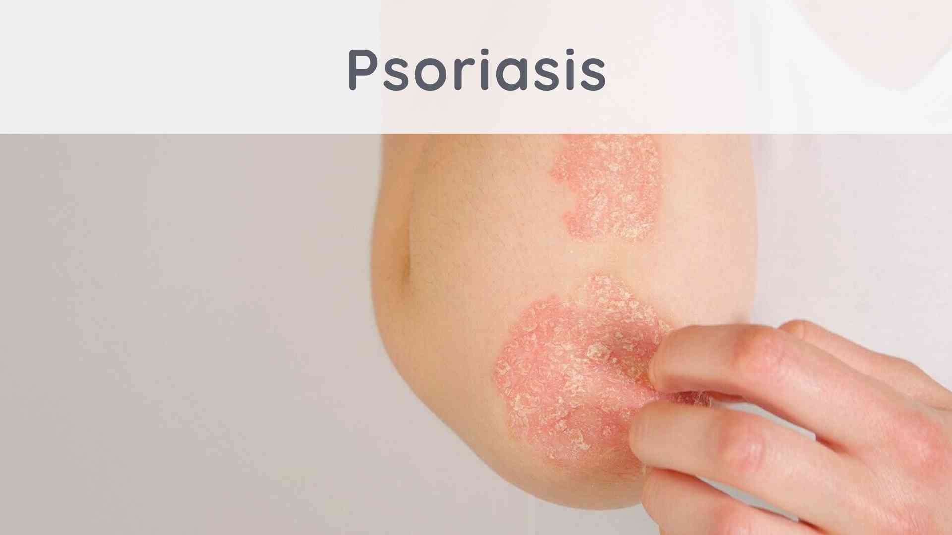 Psoriasis: can we heal naturally?