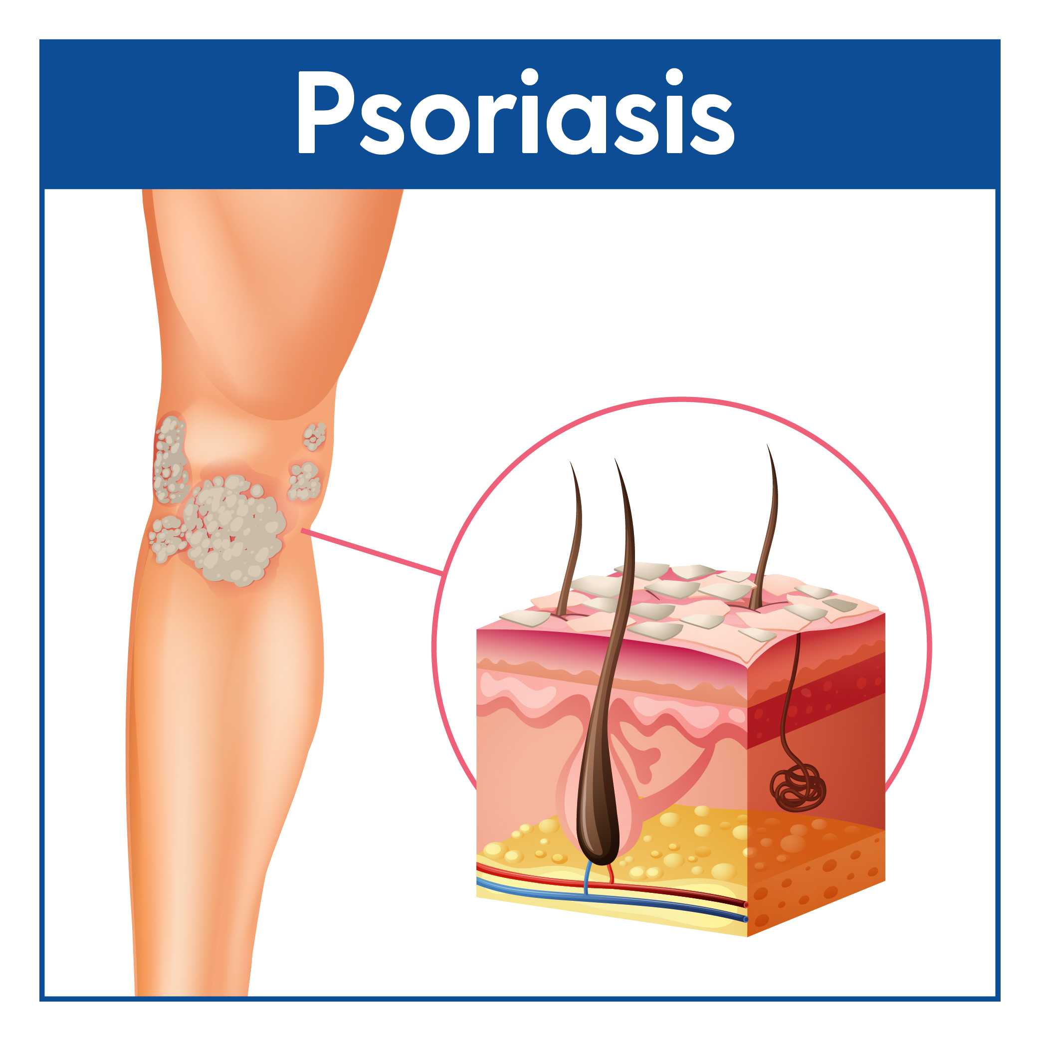 Psoriasis Causes &  Treatment  My FootDr