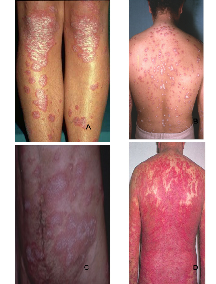 Psoriasis clinical manifestations: A