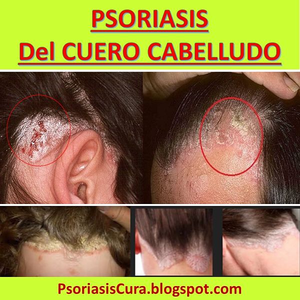 Psoriasis Cura: Psoriasis en el Cuero Cabelludo: SÃntomas ...