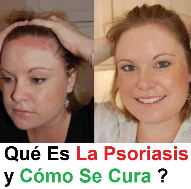 Psoriasis Cura: Qué es la Psoriasis Como se Cura ...