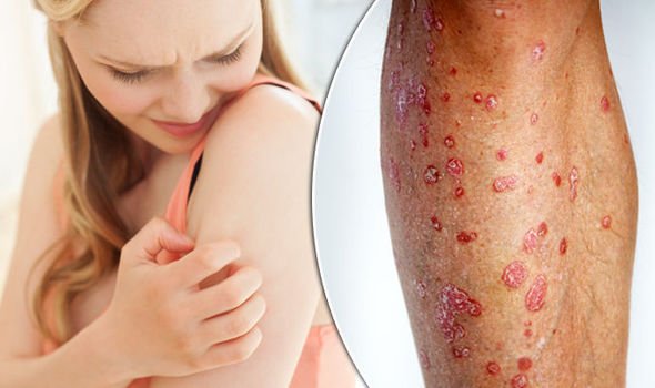 Psoriasis cures: THESE three treatments may alleviate symptoms ...