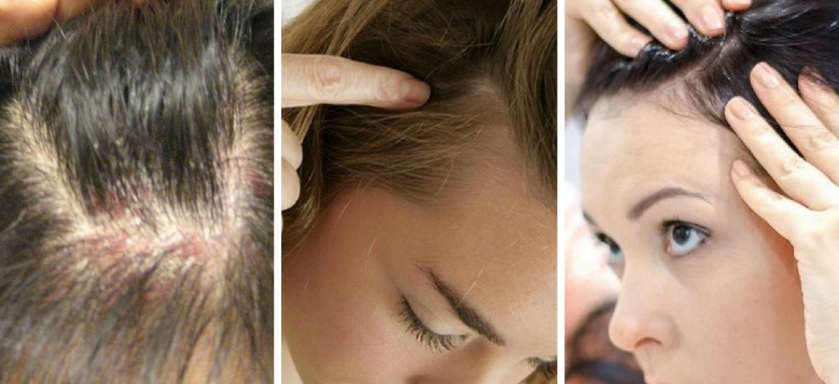 Psoriasis del cuero cabelludo, causas, síntomas y ...
