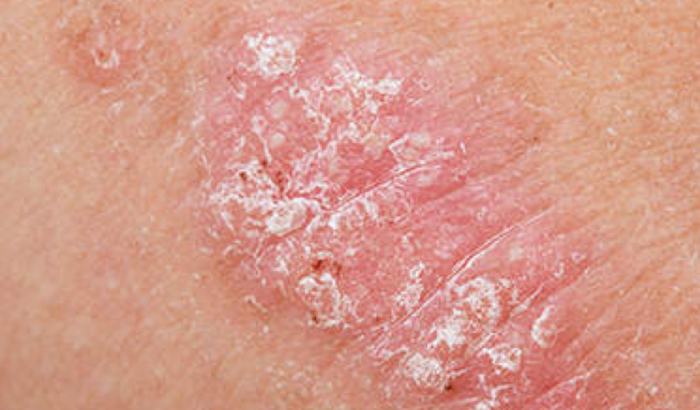PSORIASIS  Dermatology Conditions and Treatments