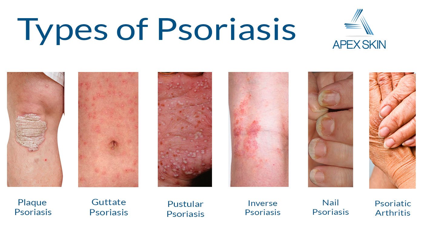 psoriasis , diagnosis and treatment