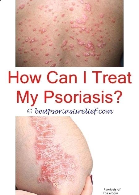 Psoriasis Diet â psoriasistoenails psoriasis and gout ...