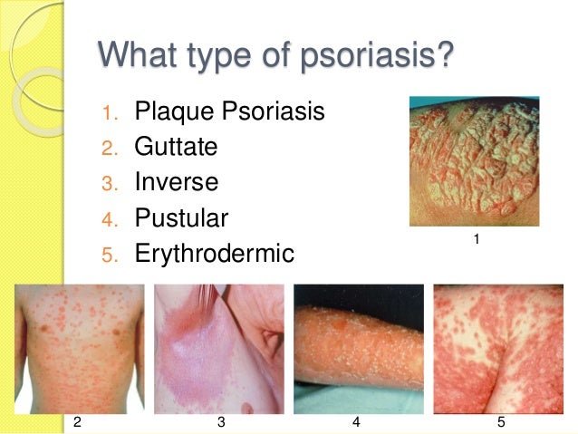 Psoriasis Diet, Pictures, Treatment, Symptoms and Causes