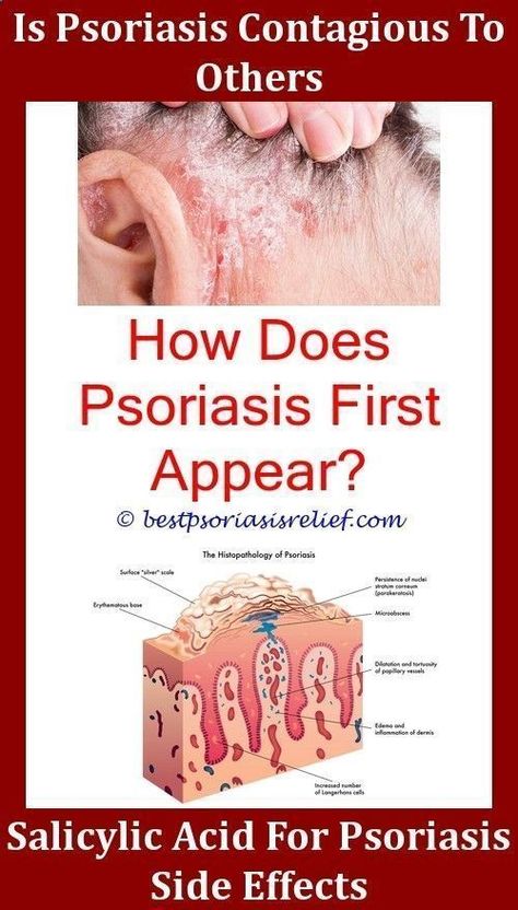 Psoriasis Diet Scalp Psoriasis How To Treataloe vera for psoriasis ...