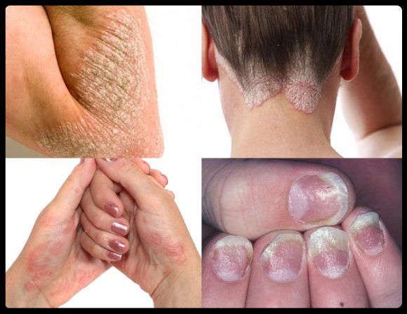 psoriasis dr health clinic