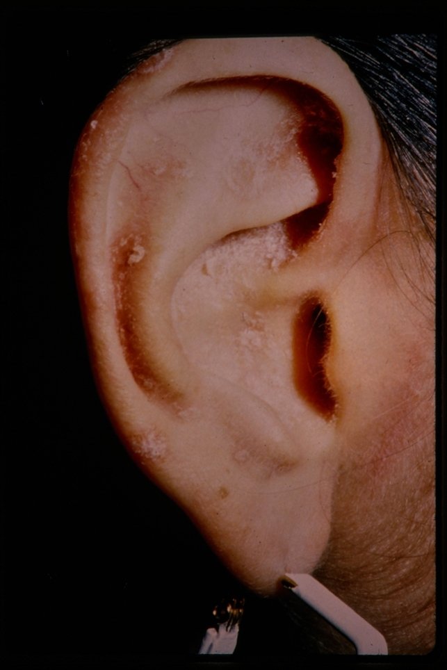 Psoriasis ear