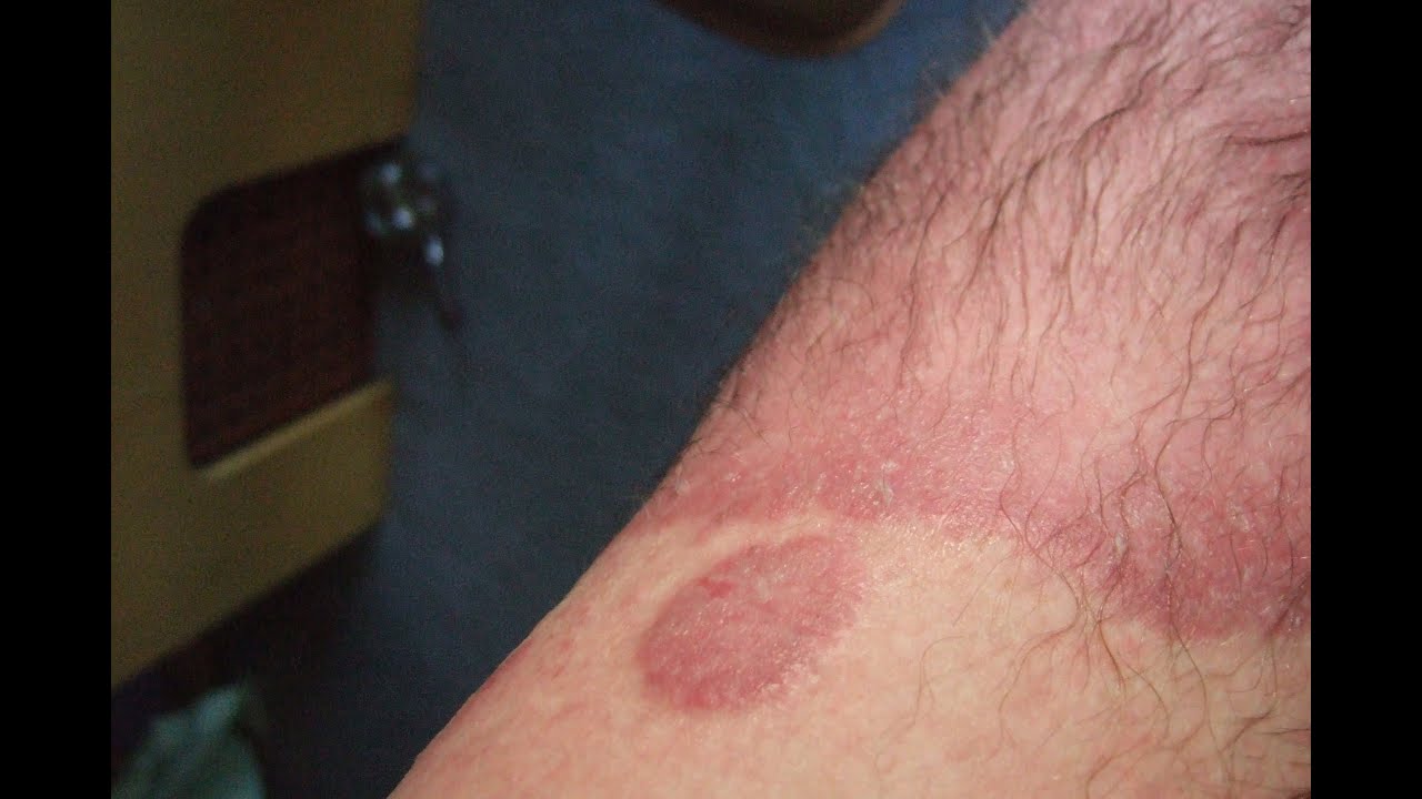 Psoriasis Eczema Sucks Why Skin Conditions Suck #22