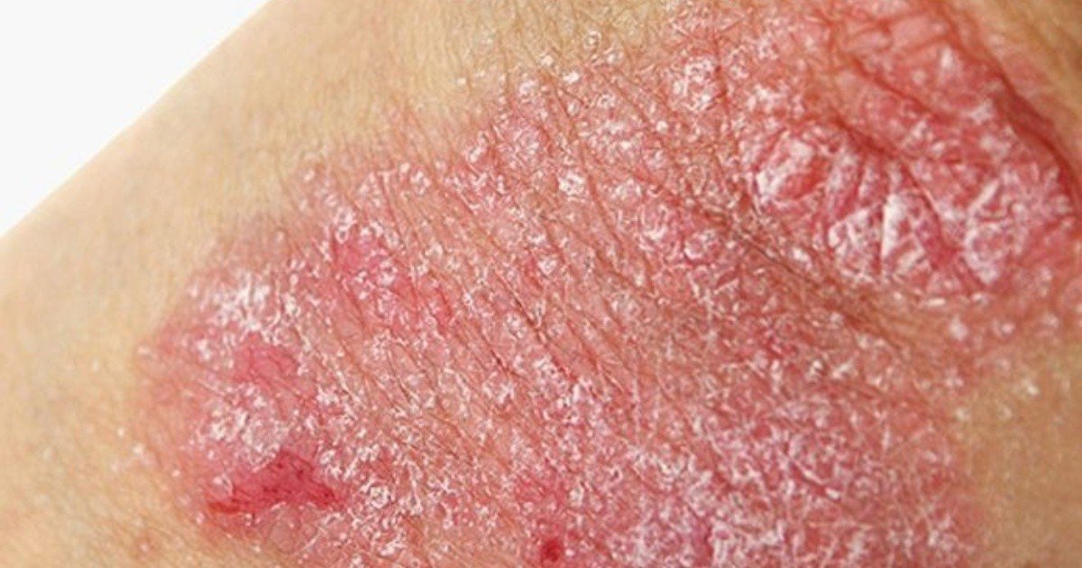 Psoriasis, enfermedad de la piel que impacta emocionalmente