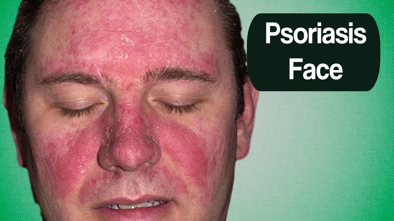 Psoriasis Face, Home Remedies For Scalp Psoriasis, Natural ...