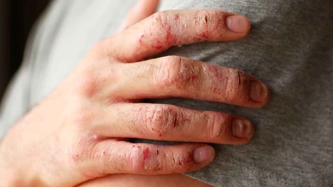 Psoriasis Fingers