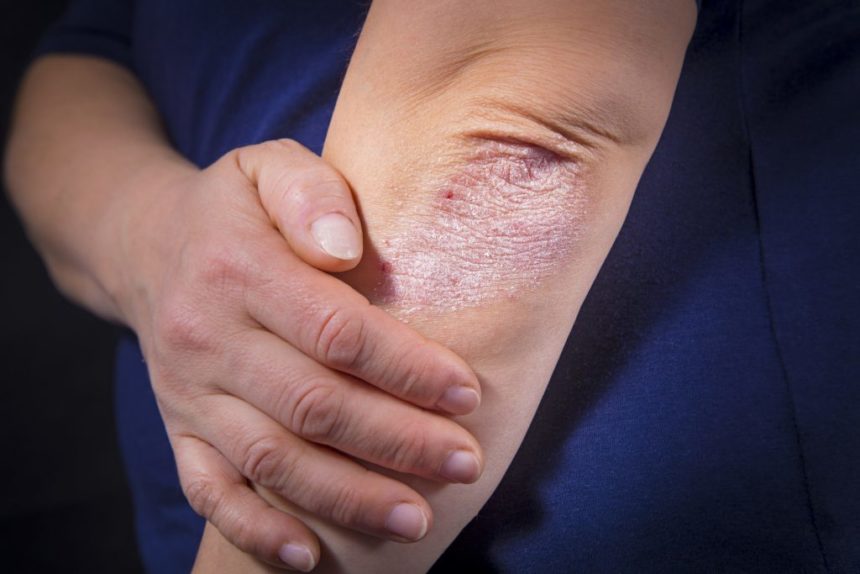 psoriasis flare ups in fluctuating weather dr health clinic