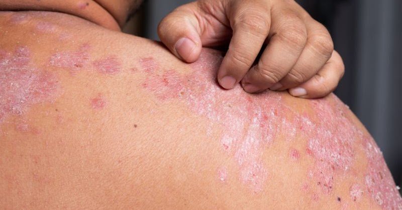 Psoriasis Help 4 Friends: Psoriasis: Why sufferers might be ...