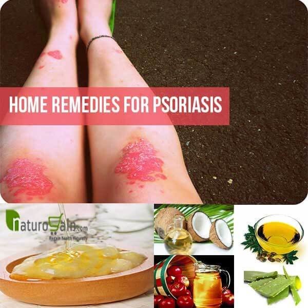 Psoriasis Home Remedies