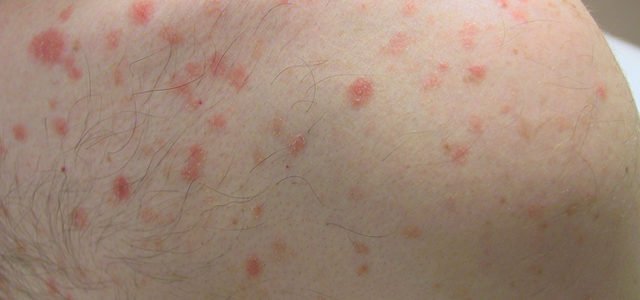 Psoriasis How Does It Spread