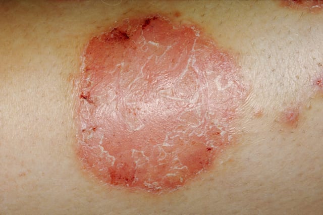 Psoriasis In Children: Causes And Treatment