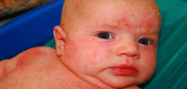 Psoriasis In Children: Treatment, Symptoms And Causes ...