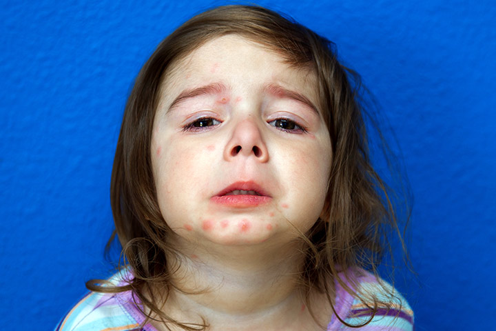 Psoriasis In Children: Types, Symptoms And Treatment