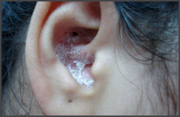 Psoriasis in ear canal pictures