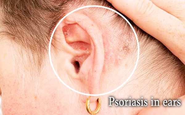 Psoriasis in ears â Causes, Symptoms &  Treatment