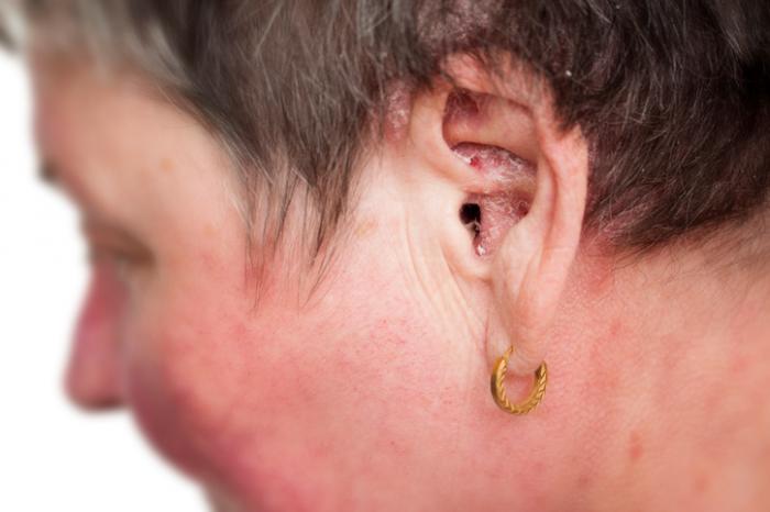 Psoriasis in the ears: Treatment and symptoms