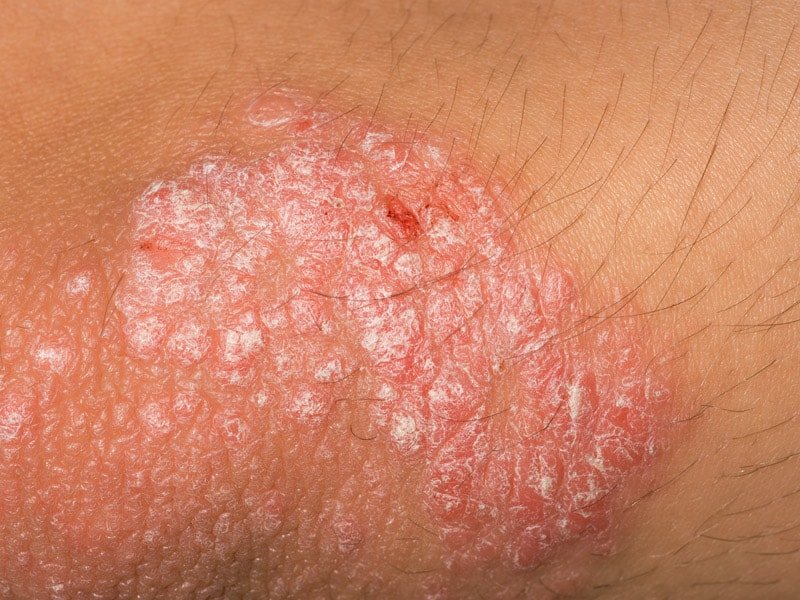 Psoriasis: Joint Inflammation, Pain May Predict PsA