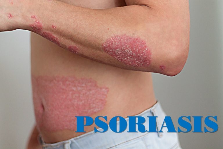 Psoriasis Linked to Cardiovascular Disease