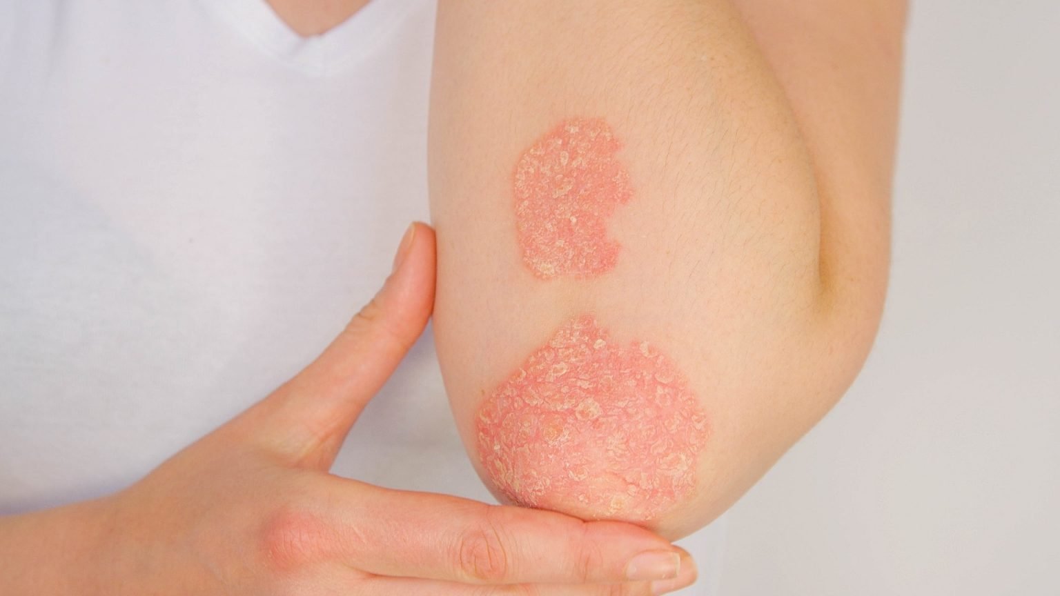 Psoriasis linked to increased Ca incidence and mortality ...