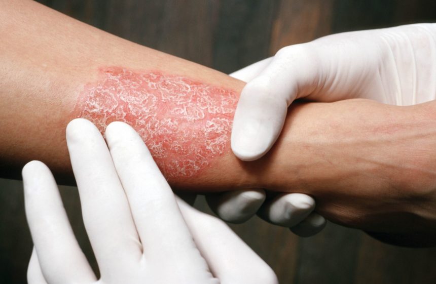 Psoriasis Linked to Increased Risk for Inflammatory Bowel ...