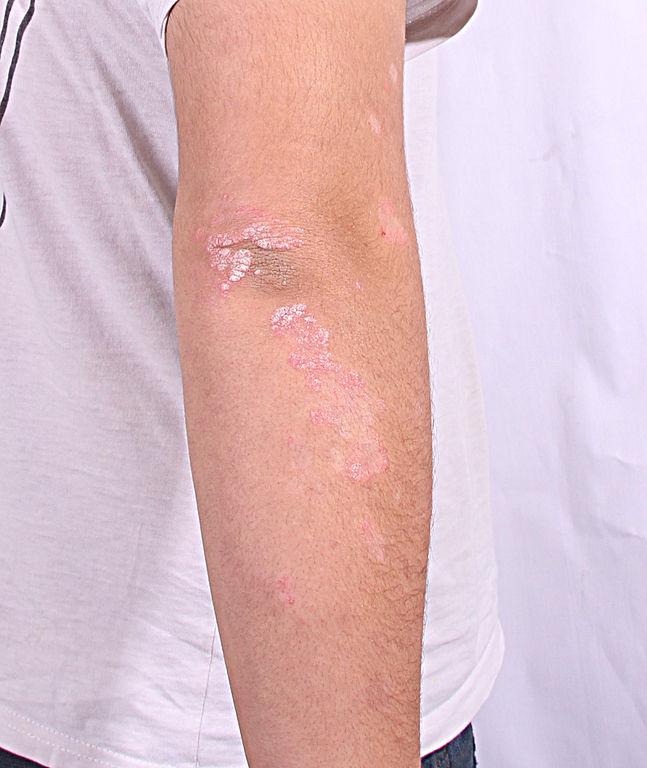 Psoriasis Linked To Other Serious Conditions, Including ...