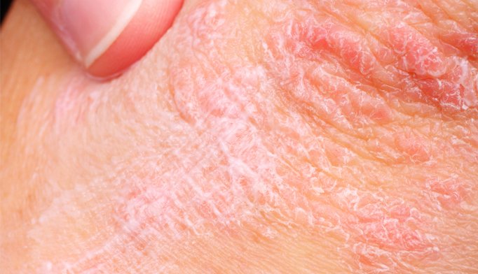 Psoriasis may be triggered by nerve cells responsible for feeling pain ...