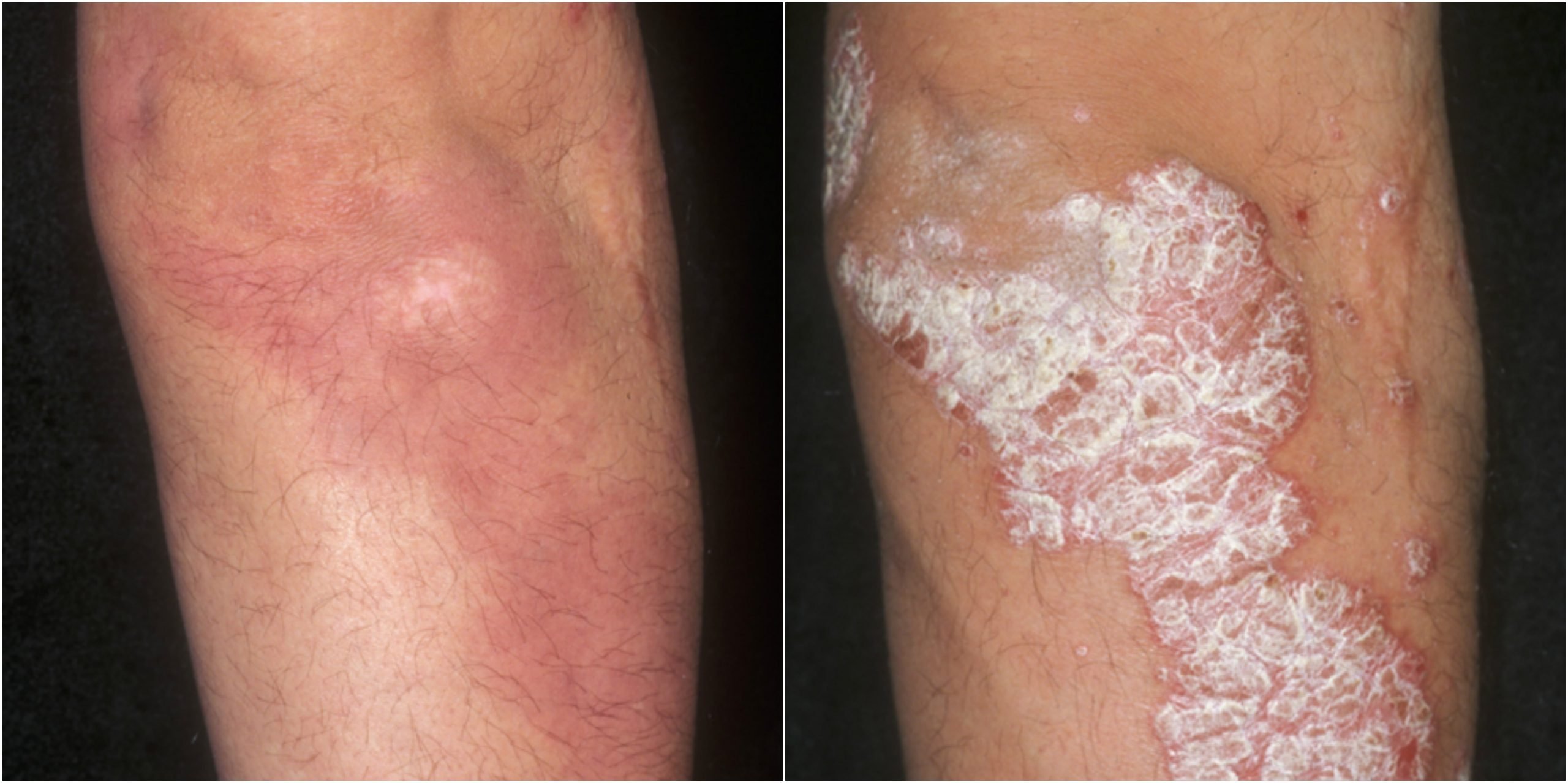 Psoriasis: new treatments, excellent results
