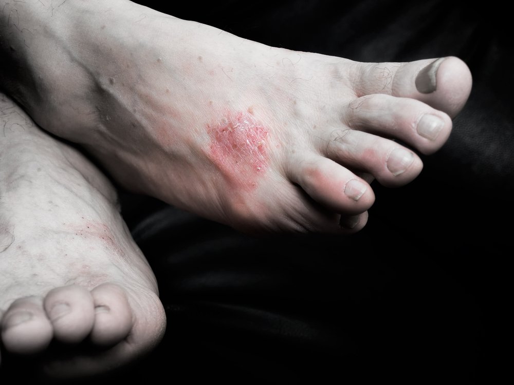 Psoriasis of Feet