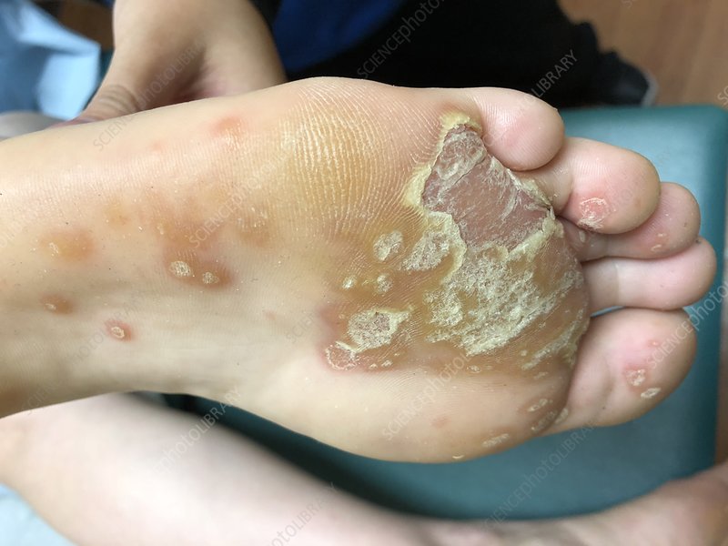 Psoriasis of sole of foot