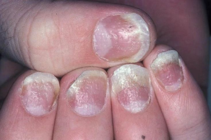 Psoriasis of the fingernails and toenails can cause your ...